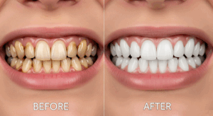 A before and after image showing the dramatic results of a professional teeth whitening treatment.